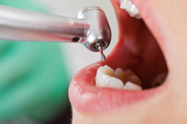 Best Chipped Tooth Repair Near Me  in Spencerville, OH